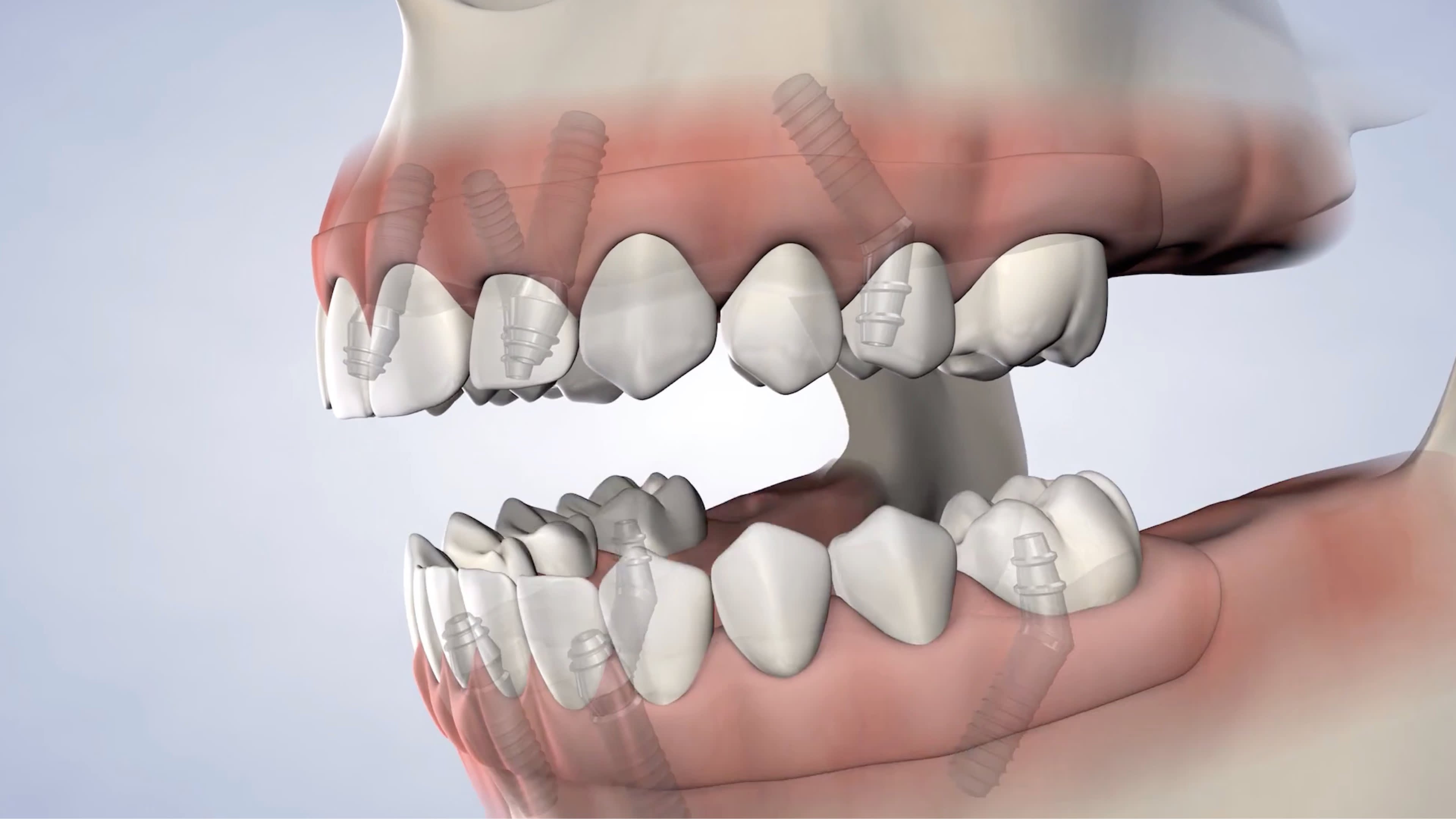 Illustration of full-arch restoration