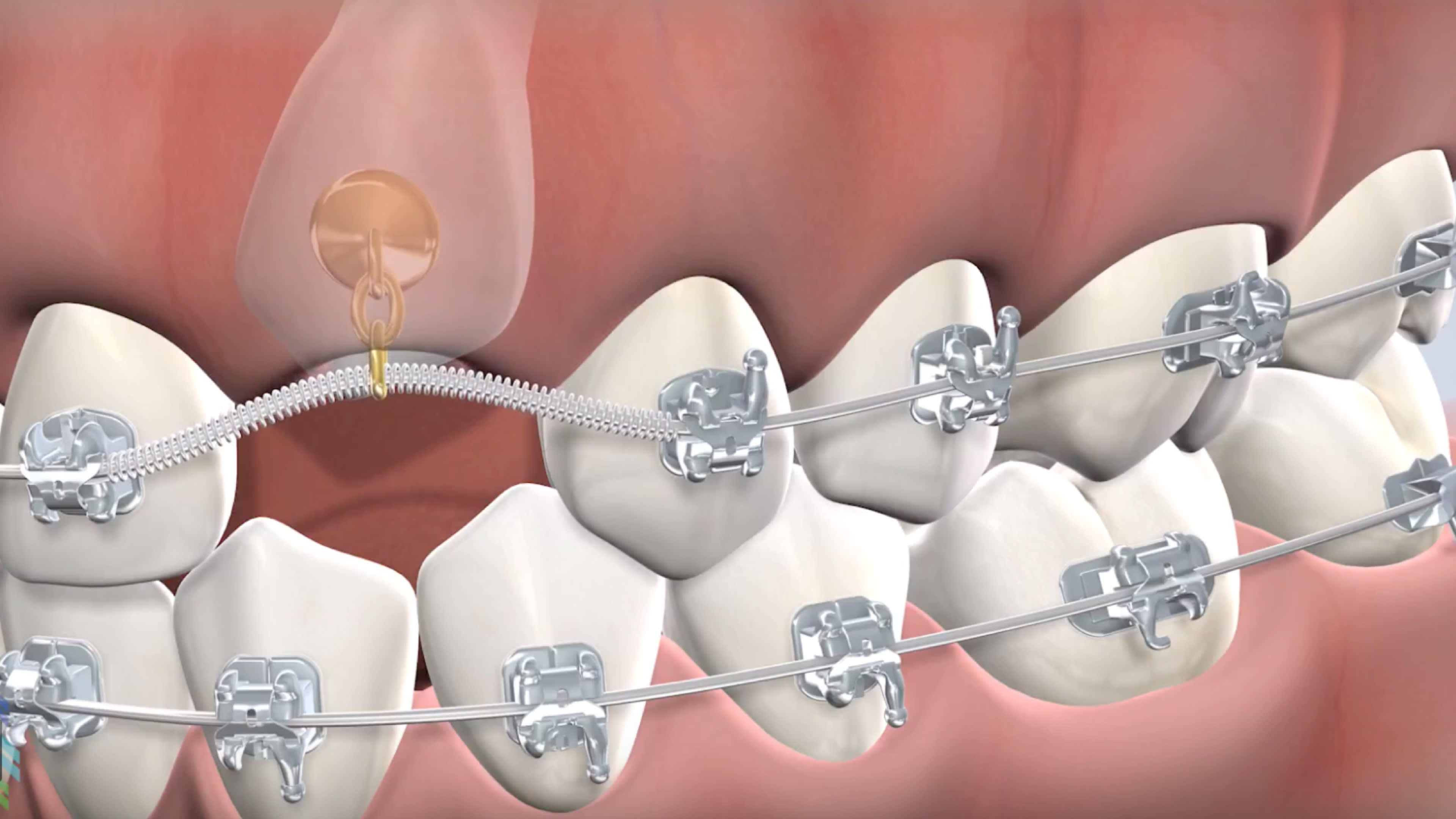 Illustration of an impacted canine