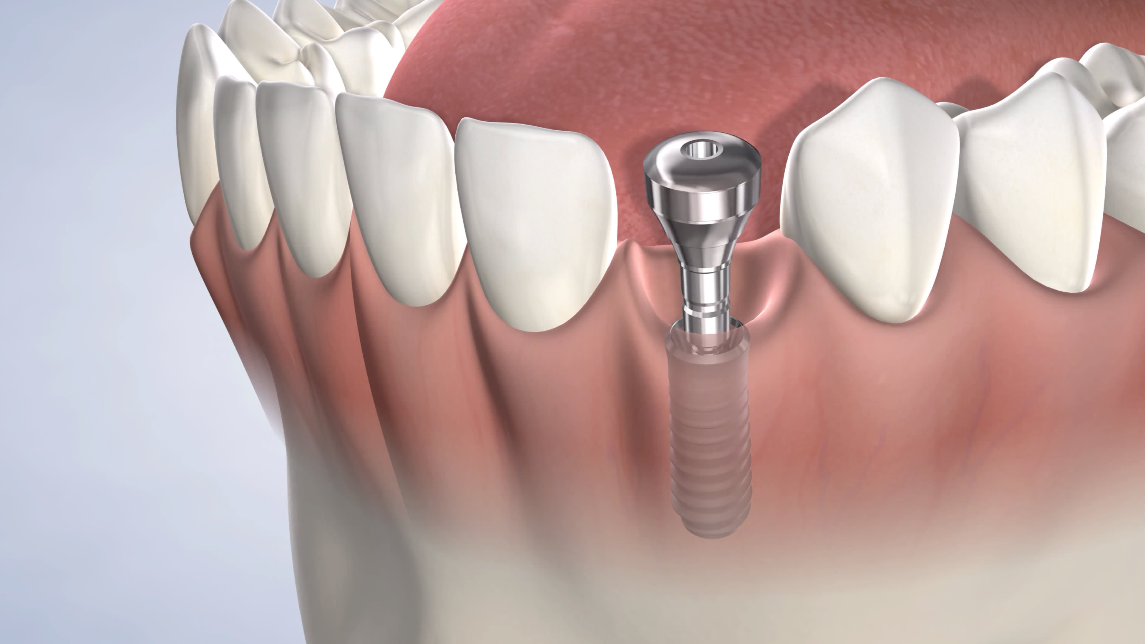 Illustration of a dental implant post | Mount Pleasant, SC