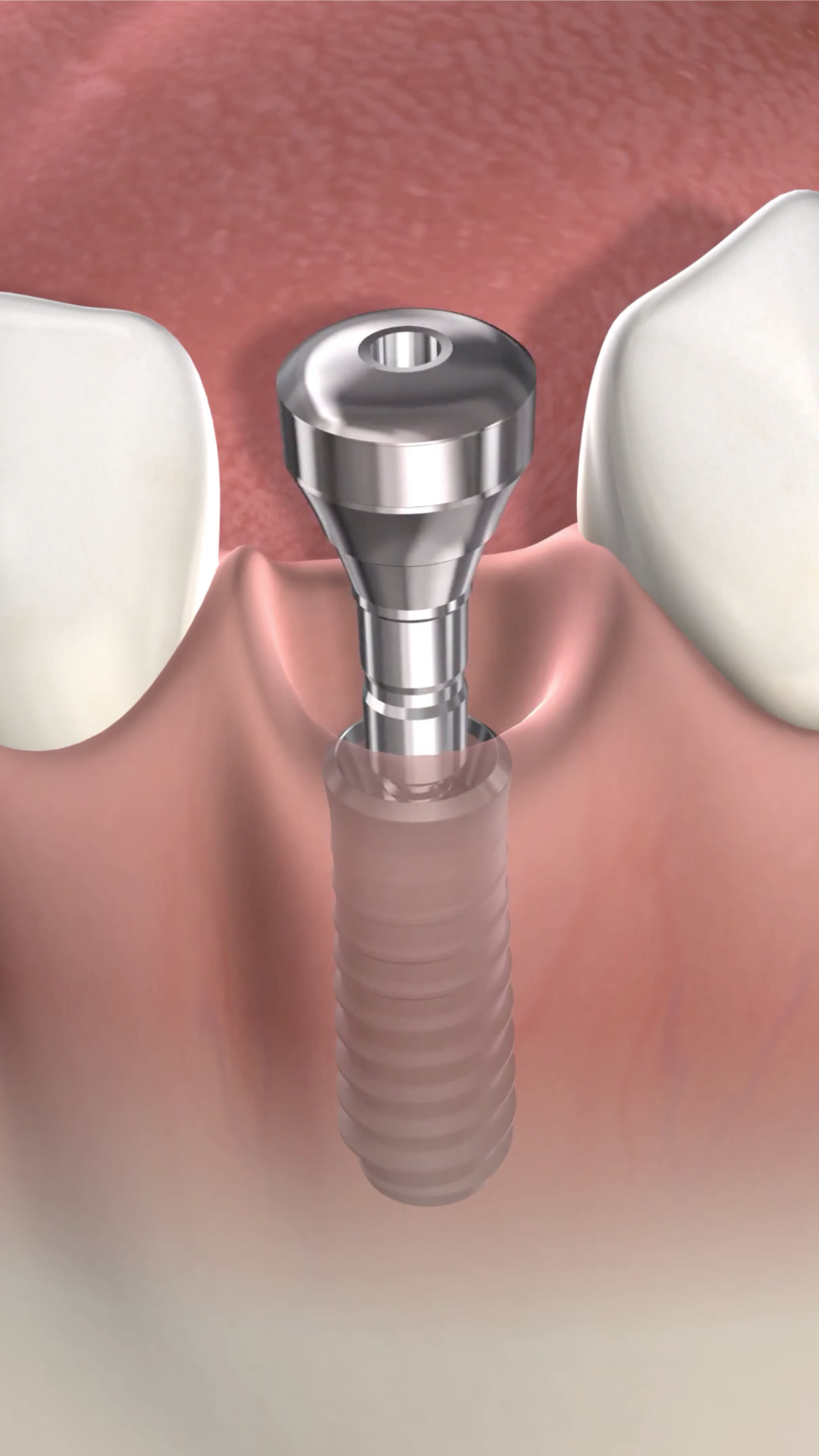 Illustration of a dental implant post | Mount Pleasant, SC